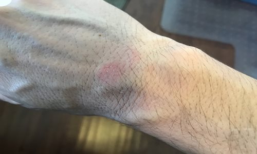 Dry-Skin-Wrist.JPG