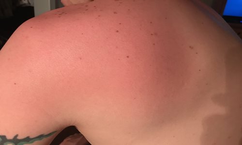 Sunburn-Shoulder.JPG